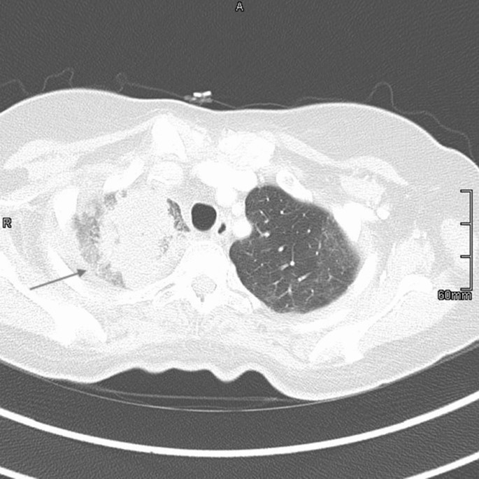 Breakthrough Hormographiella Aspergillata Infection In A Patient With Acute Myeloid Leukemia Receiving Posaconazole Prophylaxis A Case Report And Review Springerlink