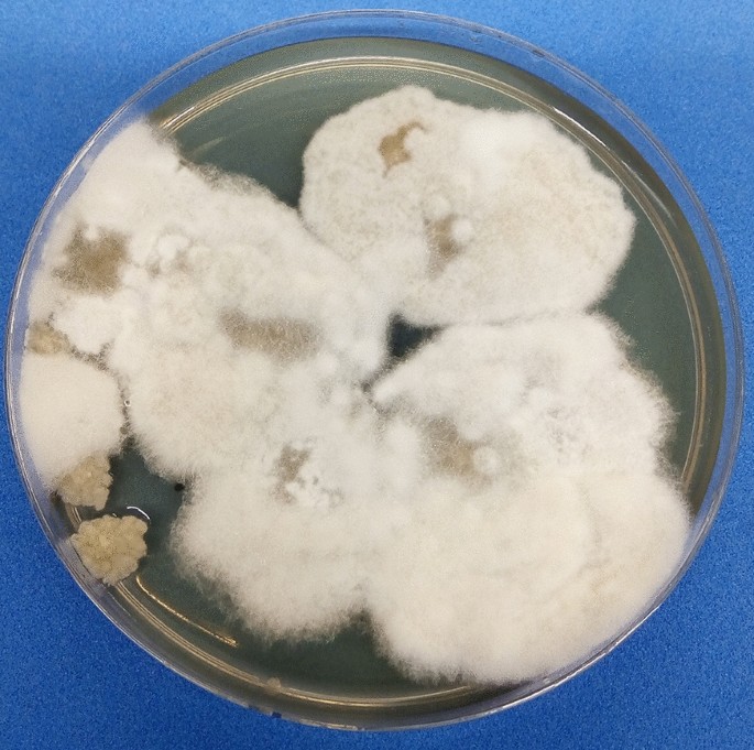 Breakthrough Hormographiella Aspergillata Infection In A Patient With Acute Myeloid Leukemia Receiving Posaconazole Prophylaxis A Case Report And Review Springerlink