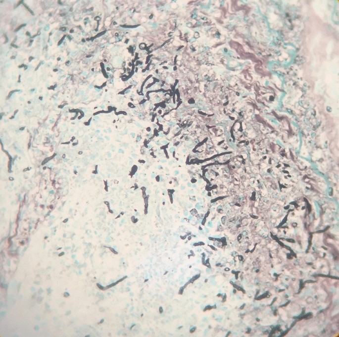Breakthrough Hormographiella Aspergillata Infection In A Patient With Acute Myeloid Leukemia Receiving Posaconazole Prophylaxis A Case Report And Review Springerlink