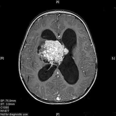 plexus papilloma definition arde după îndepărtarea verucilor genitale