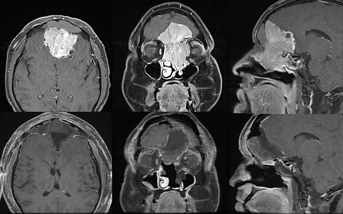 Management of olfactory neuroblastoma, neuroendocrine carcinoma, and  sinonasal undifferentiated carcinoma involving the skullbase | SpringerLink