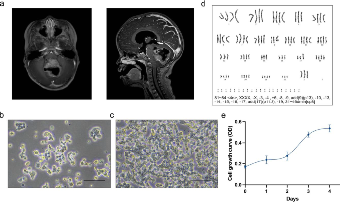 PUMC-MB1 is a novel group 3 medulloblastoma preclinical model, sensitive to PI3K/mTOR dual inhibitor | Journal of Neuro-Oncology pumc-mb1-is-a-novel-group-3-medulloblastoma-preclinical-model-sensitive-to-pi3k-mtor-dual-inhibitor-journal-of-neuro-oncology