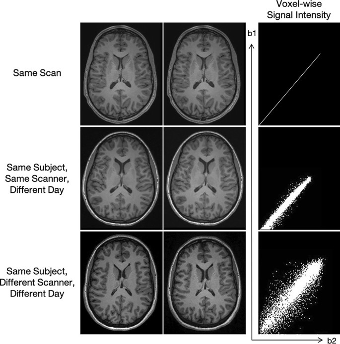 Diffusion Tensor Imaging in Traumatic Brain Injury, Neuropsychology