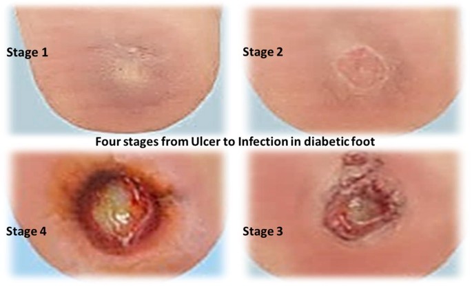 Role of growth factors and cytokines in diabetic foot ulcer healing: A detailed review | SpringerLink Role of growth factors and cytokines in diabetic foot ulcer healing: A detailed review | SpringerLink