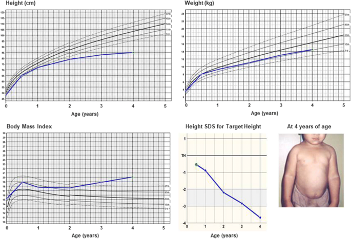Growth Hormone Deficiency And Replacement In Children | Springerlink