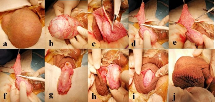 jaboulay s technique contrasted with a novel hydrocelectomy technique using a vessel sealer in the treatment of adult hydrocele a prospective randomized study springerlink jaboulay s technique contrasted with a novel hydrocelectomy technique using a vessel sealer in the treatment of adult hydrocele a prospective randomized study springerlink
