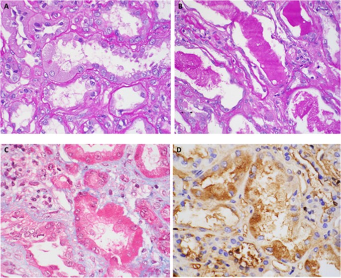 An unusual cause of renal tubular dysfunction in multiple myeloma |  SpringerLink