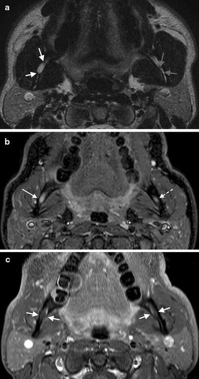 Inferior alveolar nerve, Radiology Reference Article