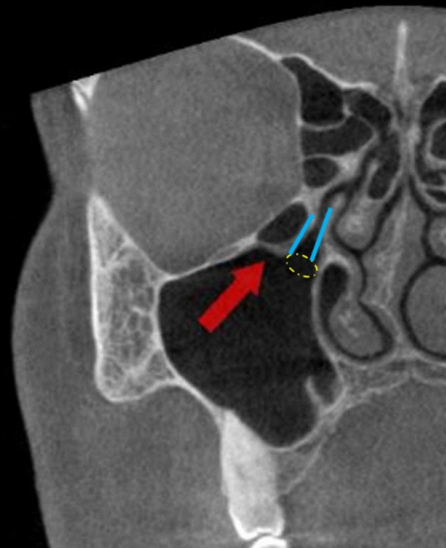 Cbct Analysis Of Haller Cells Relationship With Accessory Maxillary Ostium And Maxillary Sinus Pathologies Springerlink