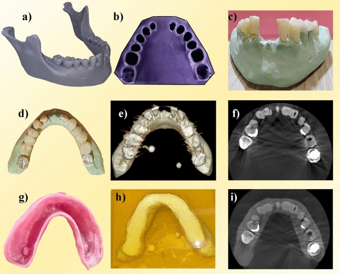 The impact of dental impression materials on metal artifacts in cone ...