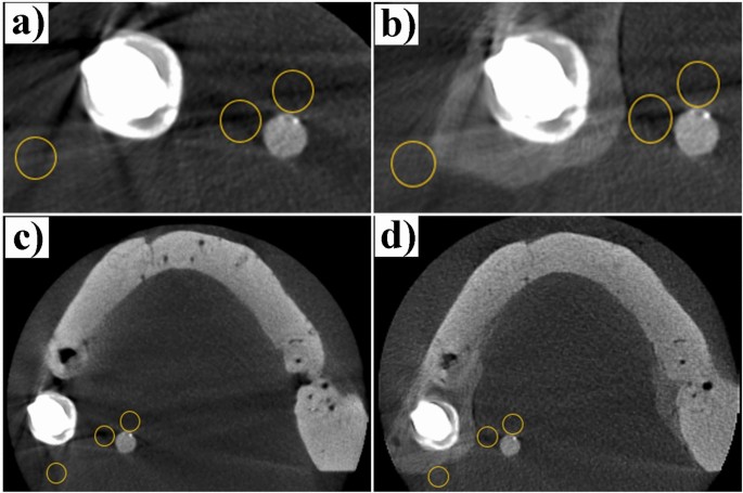 The impact of dental impression materials on metal artifacts in cone ...