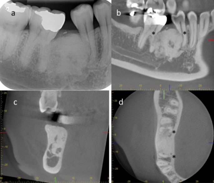 Radiographic study of osteoma: experiences from two dental schools ...