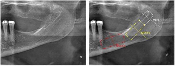 Mandibular canal cortical assessment for screening low bone mineral ...