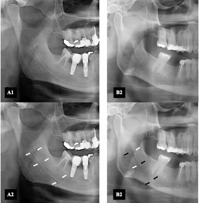 Mandibular canal cortical assessment for screening low bone mineral ...