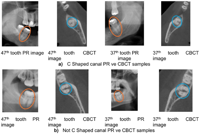 Evaluation of the accuracy of detecting C-shaped canals in mandibular ...