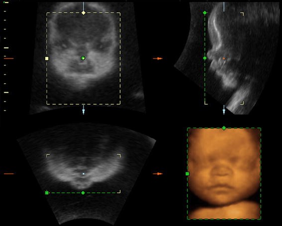 Current 3d 4d Ultrasound Technology In Prenatal Diagnosis Springerlink Current 3d 4d Ultrasound Technology In Prenatal Diagnosis Springerlink