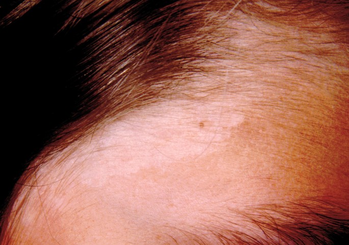 Was Pilze Alles Im Gesicht Anrichten Springerlink