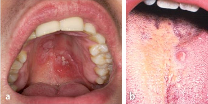 Oralverkehr mundsoor durch Pilzinfektion im