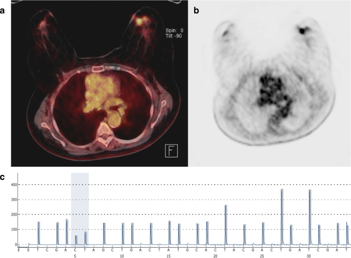 Pik3ca Mutational Status Is Associated With High Glycolytic Activity In Er Her2 Early Invasive Breast Cancer A Molecular Imaging Study Using 18 F Fdg Pet Ct Springerlink Pik3ca Mutational Status Is Associated With High Glycolytic Activity In Er Her2 Early Invasive Breast Cancer A Molecular Imaging Study Using 18 F Fdg Pet Ct Springerlink