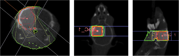 Differentiating Radiation Necrosis from Brain Tumor Using Hyperpolarized Carbon-13 MR Metabolic Imaging | SpringerLink Differentiating Radiation Necrosis from Brain Tumor Using Hyperpolarized Carbon-13 MR Metabolic Imaging | SpringerLink