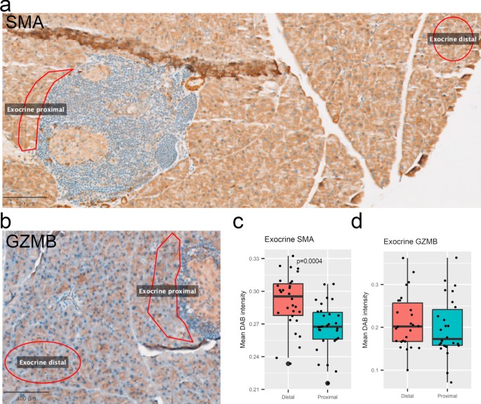 Using GeoMx DSP Spatial Proteomics to Investigate Immune Infiltration ...