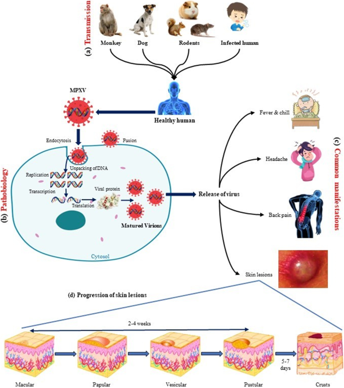 Novel severe oculocutaneous manifestations of human monkeypox virus  infection and their historical analogues - The Lancet Infectious Diseases