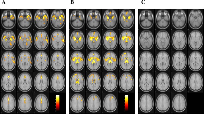 Association of sarcopenia with regional brain atrophy and white matter ...