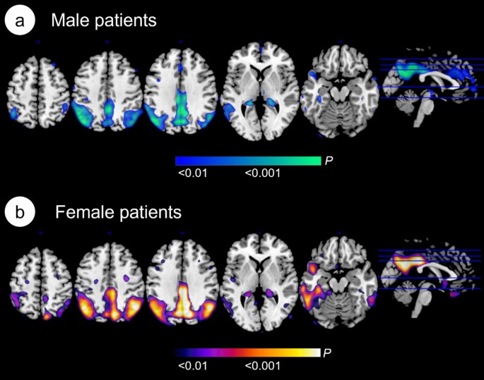 Sex differences in brain glucose metabolism in alzheimer’s disease: A ...