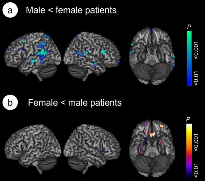 Sex differences in brain glucose metabolism in alzheimer’s disease: A ...