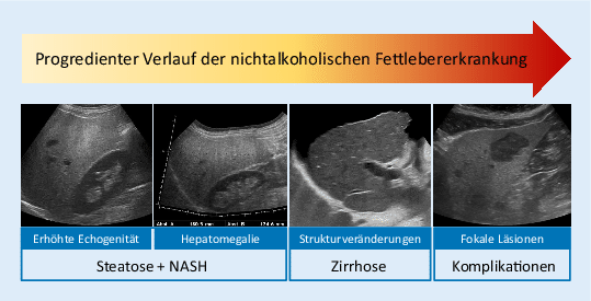 Diagnose Und Verlaufsbeurteilung Von Fettlebererkrankungen Springerlink