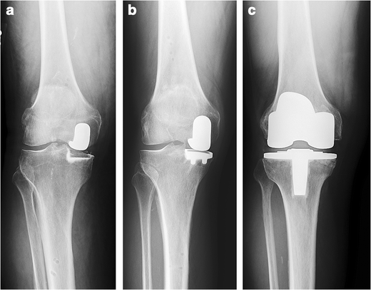 Mid-Term Outcomes Of Metal-Backed Unicompartmental Knee Arthroplasty Show  Superiority To All-Polyethylene Unicompartmental And Total Knee Arthroplasty  | Springerlink