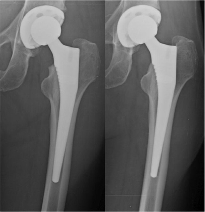The Actis And Corail Femoral Stems Provide For Similar Clinical And Radiographic Outcomes In Total Hip Arthroplasty Springerlink