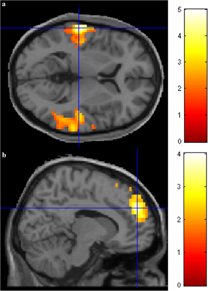 Altered brain structural and functional connectivity in cannabis users