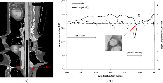 Automatic Detection Of Anatomical Landmarks Of The Aorta In Cta Images Springerlink