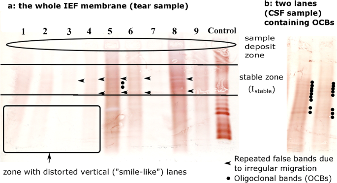 Toward an automatic tool for oligoclonal band detection in cerebrospinal  fluid and tears for multiple sclerosis diagnosis: lane segmentation based  on a ribbon univariate open active contour | SpringerLink