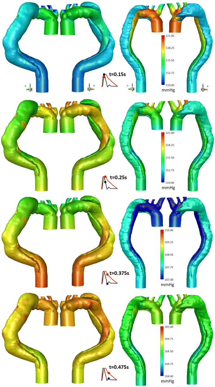 Numerical modeling of residual type B aortic dissection longitudinal analysis of favorable and unfavorable evolution SpringerLink