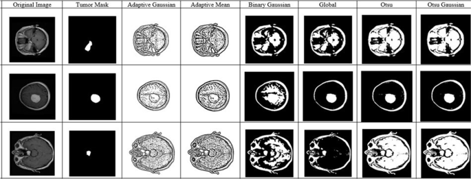 essay on brain tumor figure 11