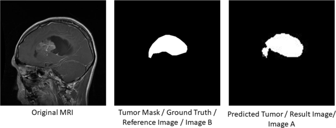 essay on brain tumor figure 17