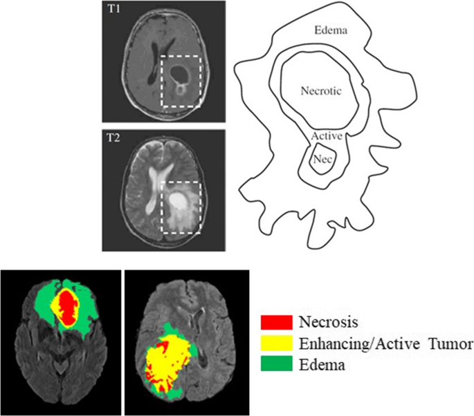 essay on brain tumor figure 1