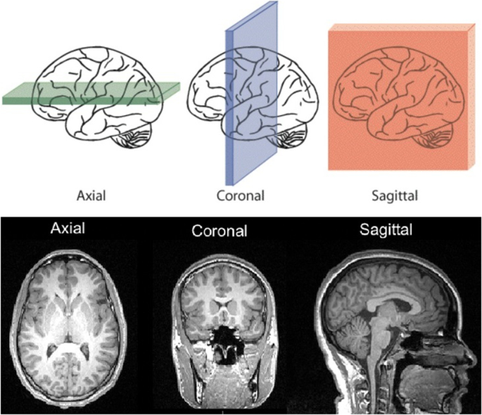 essay on brain tumor figure 2