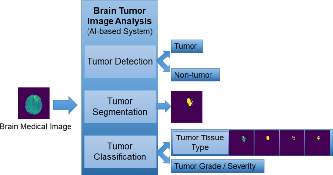 essay on brain tumor figure 5