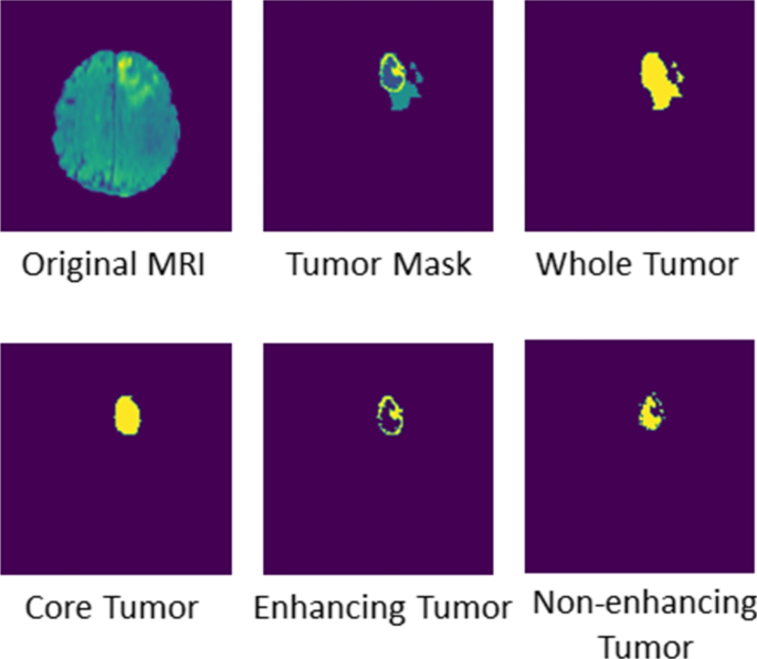essay on brain tumor figure 8