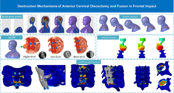 Destruction mechanism of anterior cervical discectomy and fusion in ...