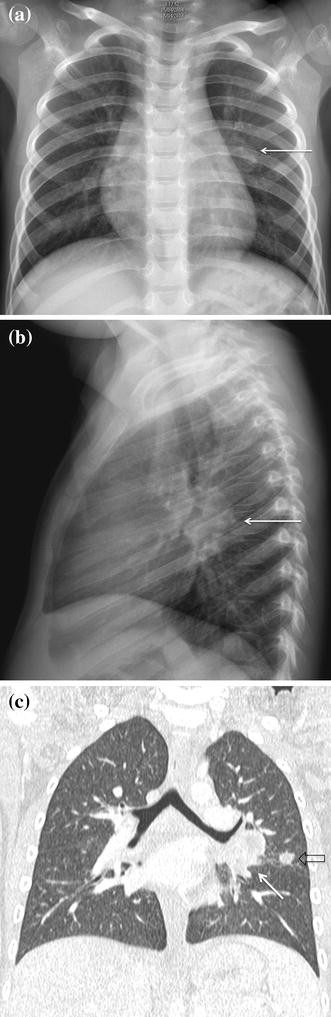 Radiological Patterns Of Childhood Thoracic Tuberculosis In A Developed Country A Single Institution S Experience On 217 255 Cases Springerlink