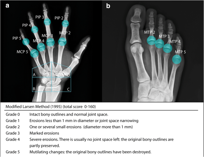 rheumatoid arthritis radiology findings