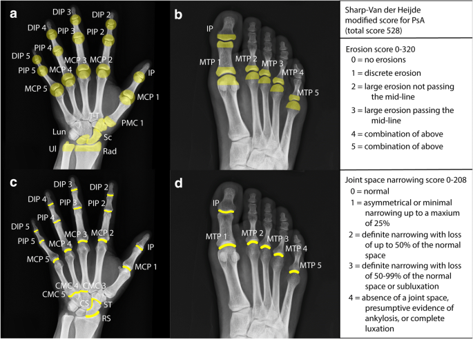 rheumatoid arthritis radiology findings
