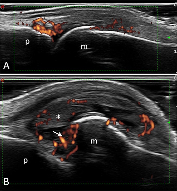 Ultrasound Imaging In Rheumatoid Arthritis | Springerlink