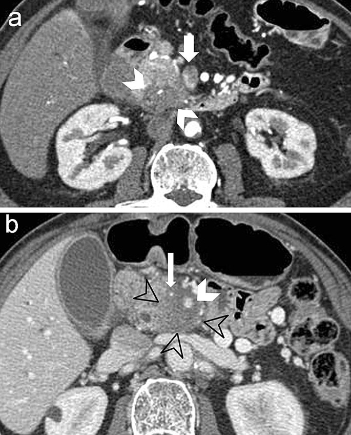 CT and MR features that can help to differentiate between focal chronic  pancreatitis and pancreatic cancer | SpringerLink