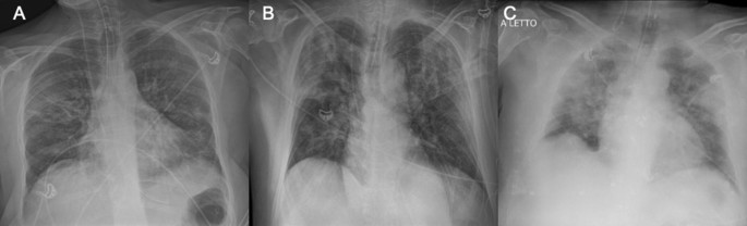 Chest X Ray In New Coronavirus Disease 2019 Covid 19 Infection