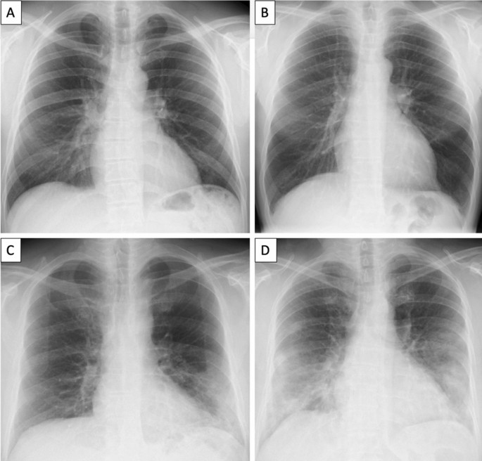Baseline Chest X Ray In Coronavirus Disease 19 Covid 19 Patients Association With Clinical And Laboratory Data Springerlink